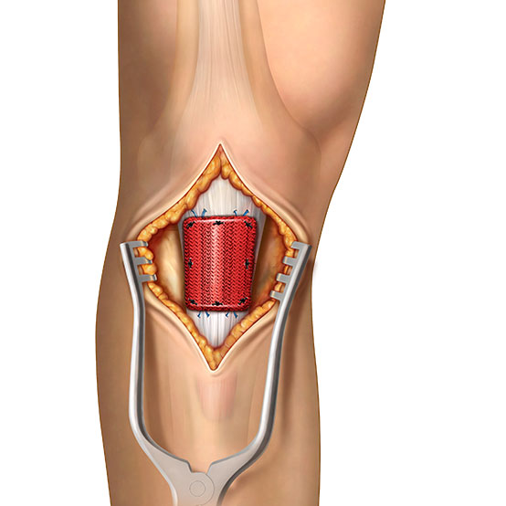 Patellar Tendon