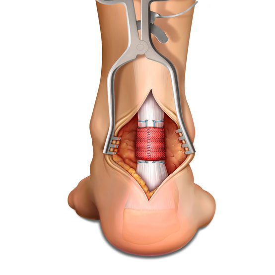 Achilles Tendon