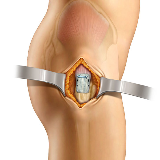 Gluteus Medius Tendon