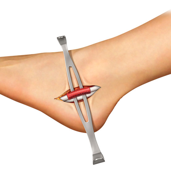 Peroneal Tendon