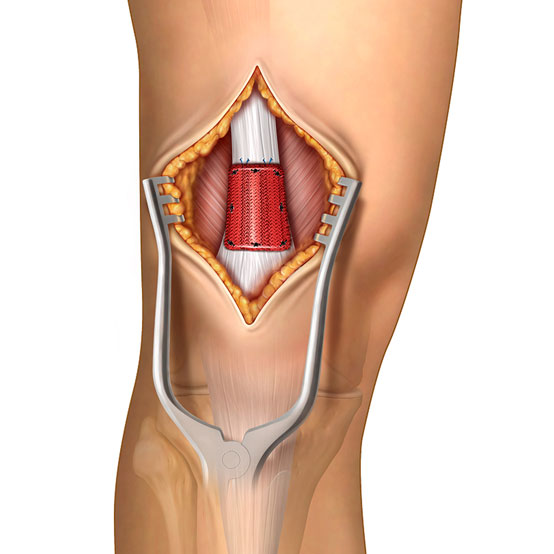 Quadriceps Tendon